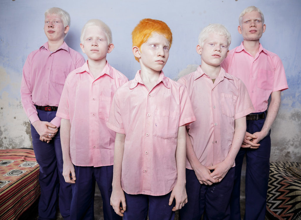 niños albinos en india